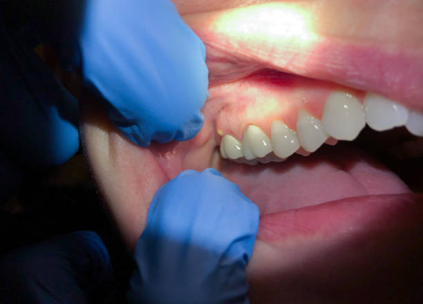 Best Emergency Root Canal Treatment in Roy, UT