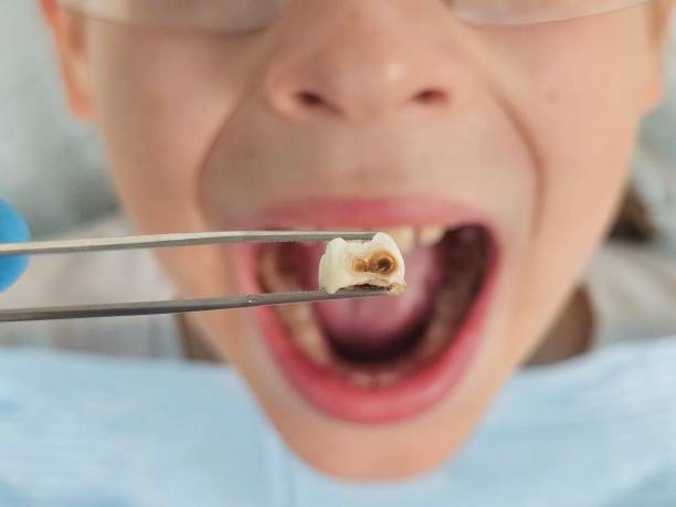 Best Broken or Cracked Tooth Emergency Dentist in Roy, UT